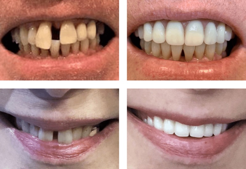 Before and After Dental Treatment by Splendent Smiles